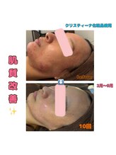 アイリス(AIRIS)/フェイシャル/毛穴洗浄/美白