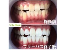 ルブラン 奈良店(Le Blanc)/きっちりしっつかり白く！！