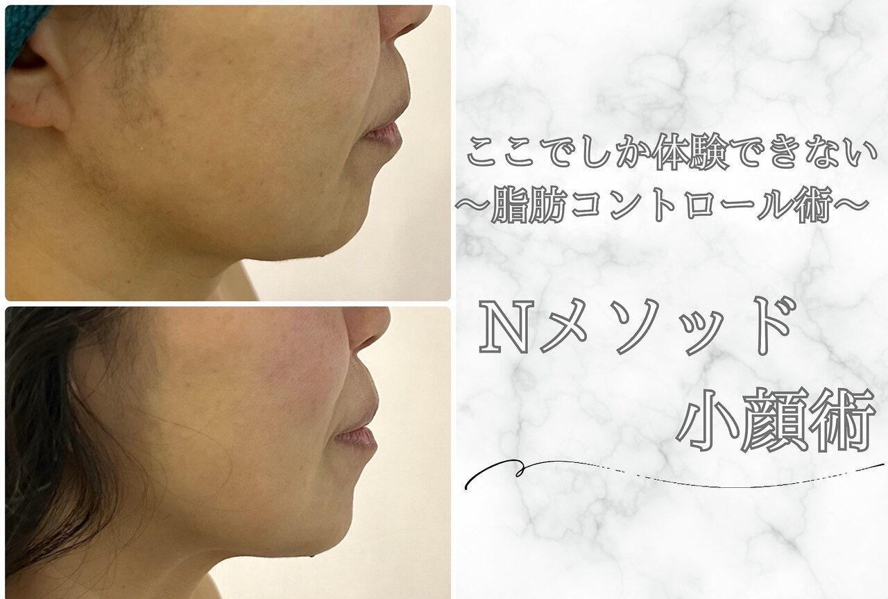 サロン専売】 美品 超音波 特許 ナール 部分痩せ ボディーケア