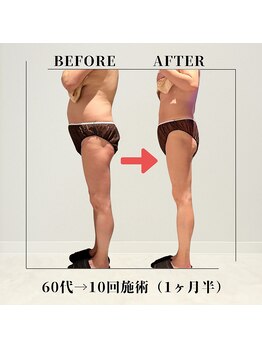 フェムビー 千葉駅前店(FEMBE)/痩身）60代の方の変化