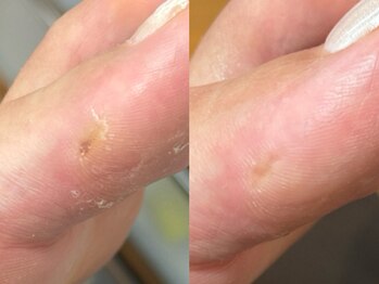 ネイルズ バイ ユイ 外苑前(Nails by Yui)/指の横の角質もすっきり◎