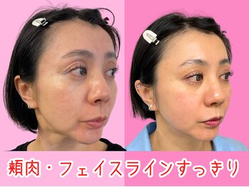 ナチュラルパーフェクトフェイス 新宿/新宿小顔/フェイスライン/むくみ