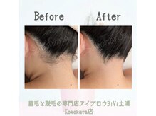 ビビ 土浦Kokokala店(BiVi)/大人気★うなじ脱毛