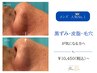 【メンズ人気No.1】黒ずみ・皮脂・毛穴が気になる方へ|REVIハーブピーリング