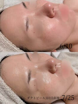 オンド(OND)/乾燥による 開き毛穴、赤み