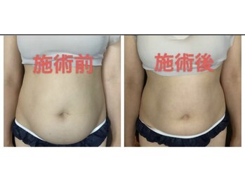 ひまわり 久屋店/新型ハイパーナイフ