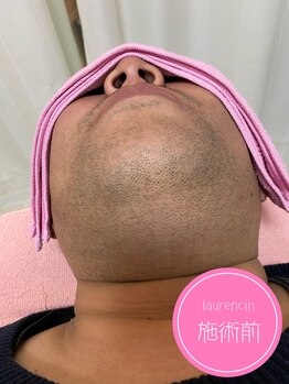 ローランサン(laurencin)/【Before3】