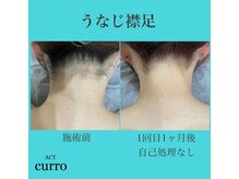 アクト クロ(ACT curro)/【うなじ襟足】脱毛施術例