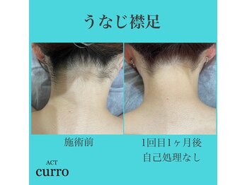 アクト クロ(ACT curro)/【うなじ襟足】脱毛施術例