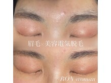 サロンロンウーマン(SALON RON woman)/青眉解消/眉毛脱毛
