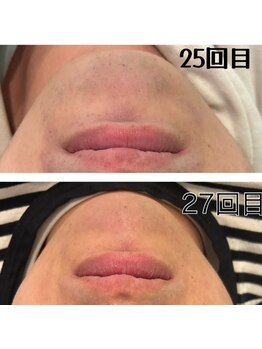 レイモード(Ray mode)/髭脱毛♪爆抜けモード