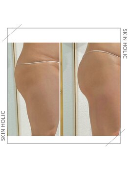 スキンホリック 恵比寿駅前店(SKIN HOLIC)/4ヶ月でヒップができました！