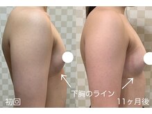 ハレオラ(HaleOla)/下胸が増えると見た目が変わる！