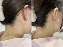 シロ(Shiro)/MIX脱毛うなじデザイン