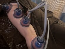 ビューティコア 二子玉川/下半身方にもカッピング痩身