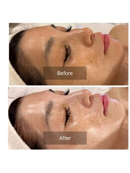 マインエム(mine.m)/刺さないリジュラン導入