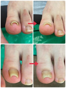 一宮巻き爪センター/巻き爪