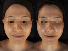 侘寂(wabisabi)/症例写真