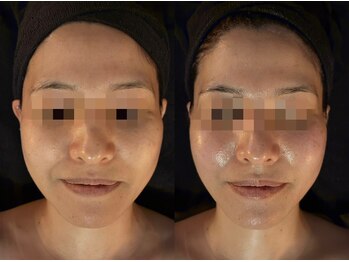 侘寂(wabisabi)/症例写真