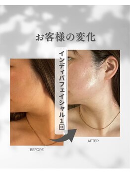 ココフルール(Cocofleur)/お手入れ1回