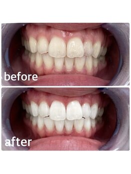 コナホワイトニング 神保町の写真/《SNSで話題のセルフホワイトニング☆》最新機器使用で美白ケア！理想の白く美しい歯をキープして印象UP！