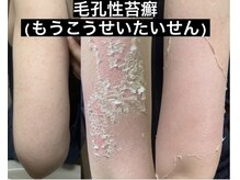 ニキビケアやお背中／二の腕の毛孔性苔癬は当店のハーブで改善◎