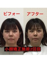 オズ六本木/六本木小顔矯正(造顔)施術2回