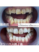 ホワイトニングサロン 京都烏丸店/ホワイトニング施術例