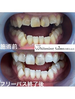 ホワイトニングサロン 京都烏丸店/ホワイトニング施術例