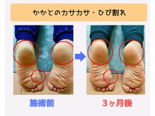 戸田はりきゅう整骨院/足指整体Before・After