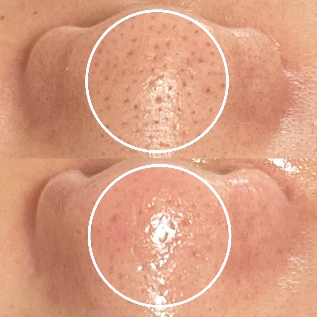 【3月限定】いちご鼻お掃除！お試し毛穴エクストラクション　\9900→\5500