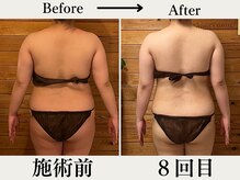 リウル(RiUll)/施術8回目の変化