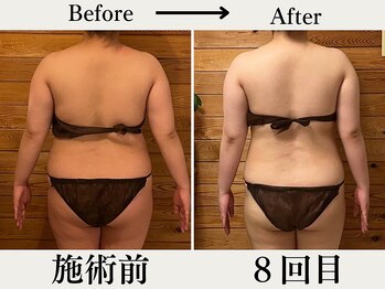 リウル(RiUll)/施術8回目の変化