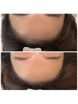 アプロディタ/骨格に合わせて可愛い輪郭提案