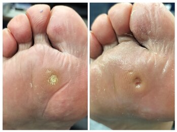 フレッシュフット(FreshFoot)/足のトラブルお任せください