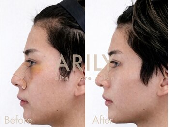 アリリィ(ARILY)/ダウンタイムケア/表参道/外苑前