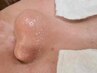 鼻の黒い毛穴、白く詰まった皮脂汚れを浮き立たせて吸引！！