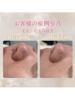 パンジー 上野フェイシャルエステ専門店(pansy)/*フェイシャル/たるみ毛穴ケア*