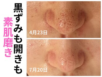 エリン(ERIN)/毛穴徹底洗浄