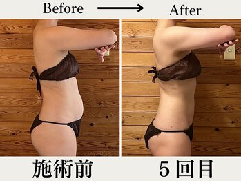 リウル(RiUll)/ぽっこりお腹を解消！