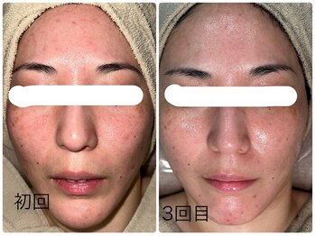 ルミネル 名古屋新栄(Luminelle)/水光ピーリング