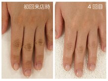 キレイテ 福岡天神店/40代/4回目【天神ハンドケア】