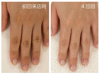 キレイテ 福岡天神店/40代/4回目【天神ハンドケア】