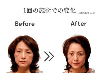 ケー(K)の写真/深層筋へアプローチ☆たるみ・ほうれい線を根本から予防&改善!フェイスラインをキュッと引き締めます。