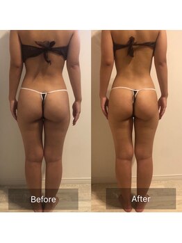 レガリア(LEGAREA)/痩身エステ