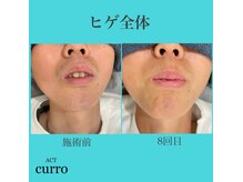 アクト クロ(ACT curro)/【ヒゲ全体】脱毛施術例