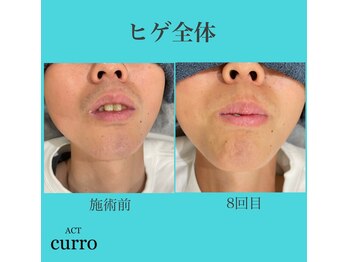 アクト クロ(ACT curro)/【ヒゲ全体】脱毛施術例