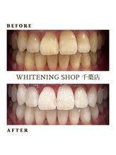 ホワイトニングショップ 千葉店/歯科提携　ホワイトニング専門店