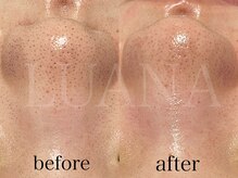 ルアナ(LUANA)/毛穴洗浄