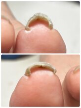 エンヴィ(ENVY)/巻爪ケア